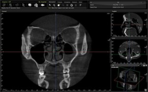 Tomografia laryngologiczna Tomografia dentystycznai laryngologiczna Poznań